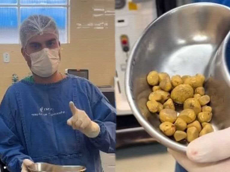 indian-man-develops-35-kidney-stones-from-excessive-soda-consumption