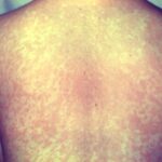wyoming-confirms-first-measles-case-in-over-a-decade-raises-public-health-concerns