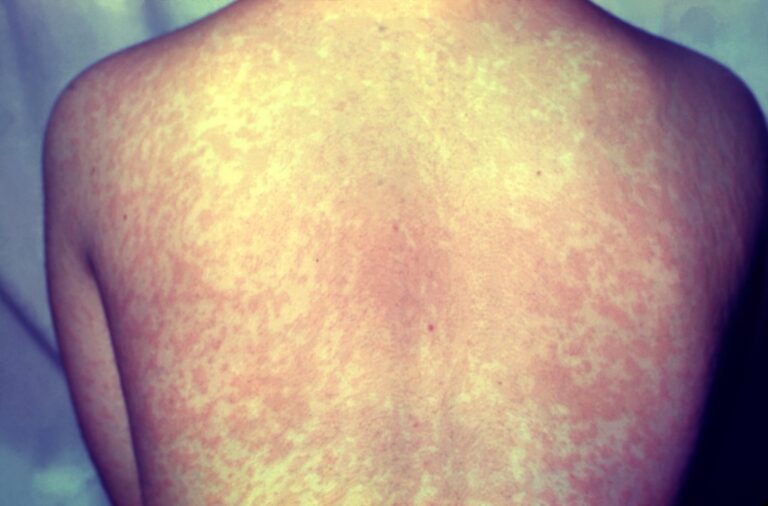 wyoming-confirms-first-measles-case-in-over-a-decade-raises-public-health-concerns